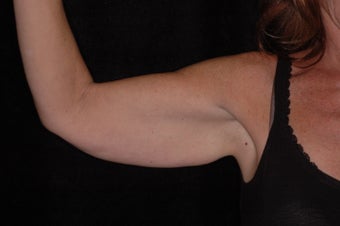 Brachioplasty for 54 year old female 1042416