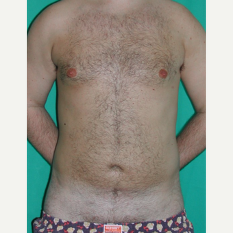 25-34 year old man treated with Liposuction after 3245921