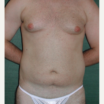 25-34 year old man treated with Liposuction before 3245921