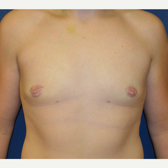 17 or under year old man treated with Male Breast Reduction after 3128654