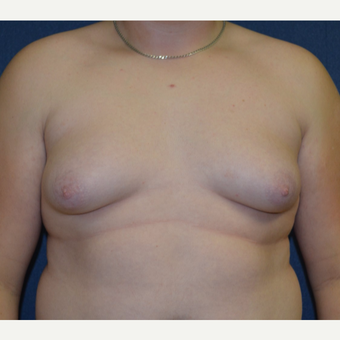 17 or under year old man treated with Male Breast Reduction before 3128654