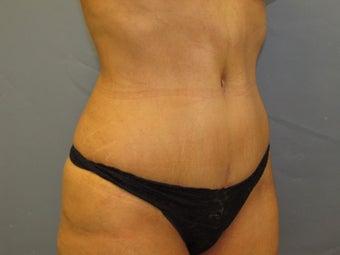 Abdominoplasty (Tummy Tuck) on 46-year-old 951018