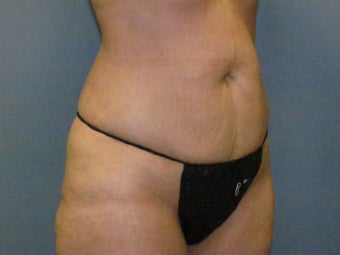 Abdominoplasty (Tummy Tuck) on 46-year-old 951018