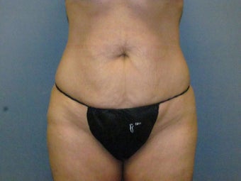 Abdominoplasty (Tummy Tuck) on 46-year-old before 951018