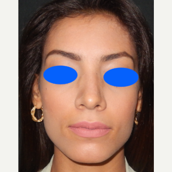 25-34 year old woman treated with Nose Surgery after 3499354