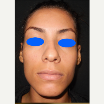 25-34 year old woman treated with Nose Surgery before 3499354