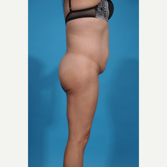 35-44 year old man treated with Brazilian Butt Lift before 3338883