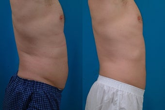 45-year-old man treated with Liposuction. after 574554