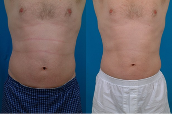 45-year-old man treated with Liposuction. before 574554