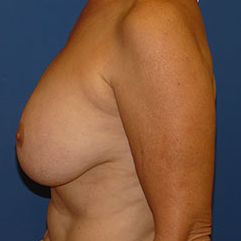 Breast Implant Removal before 2267569