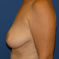 Breast Implant Removal after 2267569