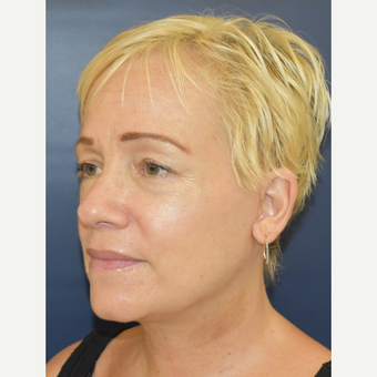 55-64 year old woman treated with Neck Lift after 3504035
