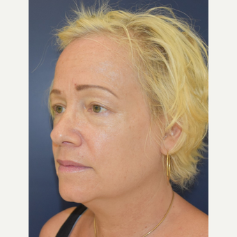 55-64 year old woman treated with Neck Lift before 3504035