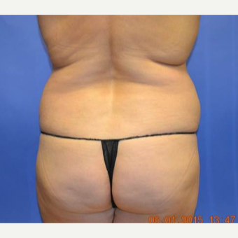 45-54 year old woman treated with Brazilian Butt Lift before 3299099