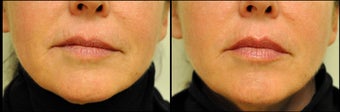 Belotero for Lip Augmentation before 981992
