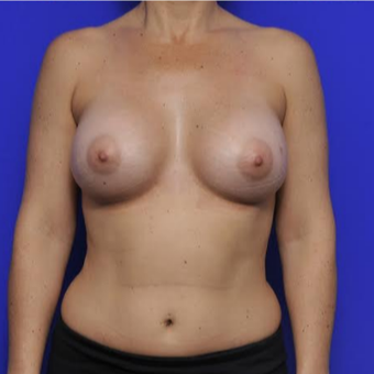 37 year old woman treated with Breast Augmentation after 3425745