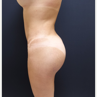 35-44 year old woman treated with Brazilian Butt Lift Revision after 3234477