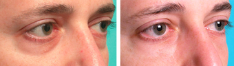 Injectable Treatments before 1200535