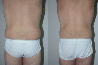 45-year-old man treated with Liposuction. after 3287556