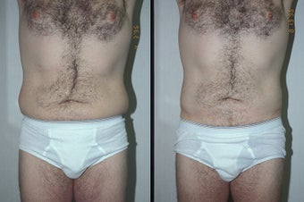 45-year-old man treated with Liposuction. before 3287556