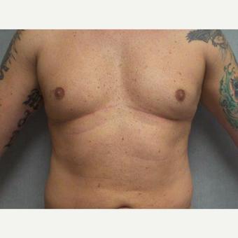 35-44 year old man treated with Male Breast Reduction after 3319929