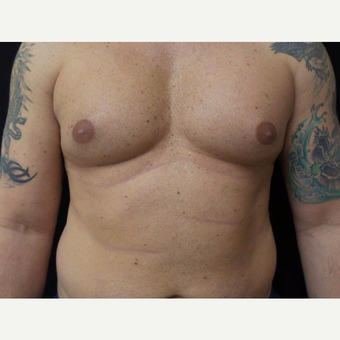 35-44 year old man treated with Male Breast Reduction before 3319929