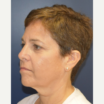 55-64 year old woman treated with Mini Lift before 3461023