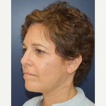 55-64 year old woman treated with Mini Lift after 3461023