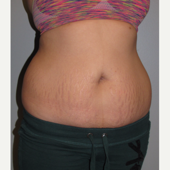 18-24 year old woman treated with Liposuction before 3140133