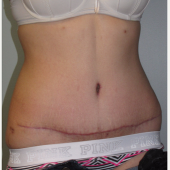 18-24 year old woman treated with Liposuction after 3140133