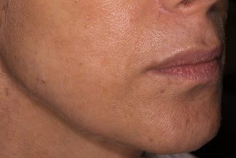 Belotero for fine etched-in lines around the mouth after 1468785