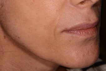 Belotero for fine etched-in lines around the mouth before 1468785
