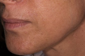 Belotero for fine etched-in lines around the mouth 1468785
