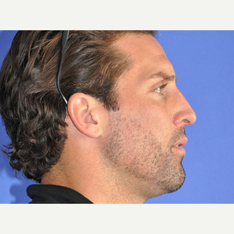 35-44 year old man treated with Rhinoplasty before 3219832