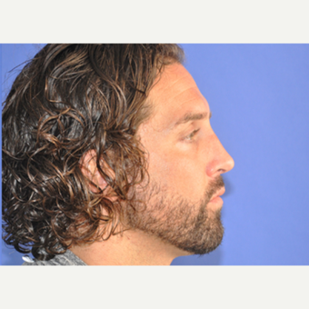 35-44 year old man treated with Rhinoplasty after 3219832