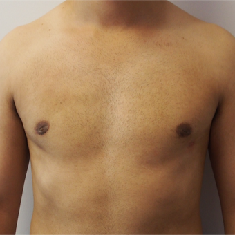 25-34 year old man treated with Male Breast Reduction after 3617411