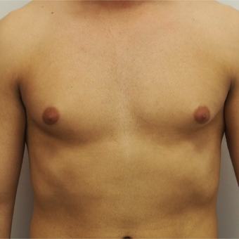 25-34 year old man treated with Male Breast Reduction before 3617411