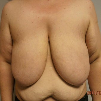 33 year old woman treated with Breast Reduction and Abdominoplasty before 1576412