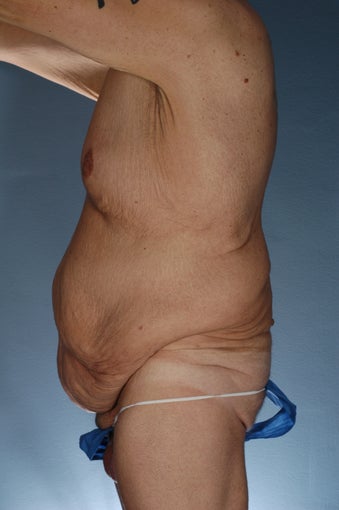 Body Lift After Weight Loss before 364635
