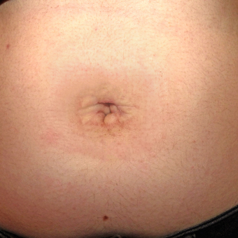 18-24 year old woman treated with Belly Button Surgery after 2749032