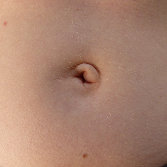 18-24 year old woman treated with Belly Button Surgery before 2749032