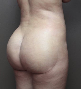 35-44 year old woman treated with Brazilian Butt Lift 3213713