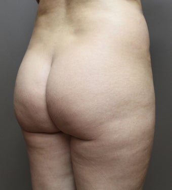 35-44 year old woman treated with Brazilian Butt Lift 3213713