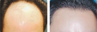 25-34 year old man treated with Hair Transplant before 3502840
