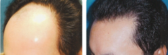 25-34 year old man treated with Hair Transplant after 3502840