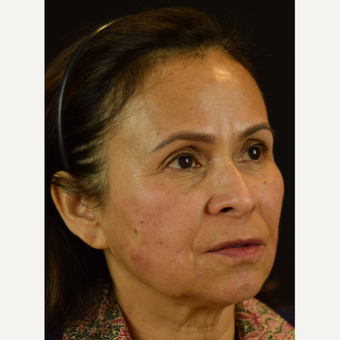 Cheek Lift, Corner of Mouth and Jowl Tightening with Novathreads after 3583055