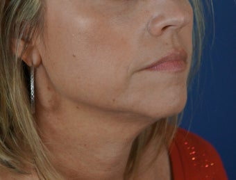 40 year old female after a liquid neck lift 782150