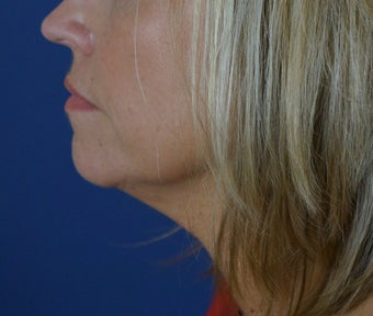 40 year old female after a liquid neck lift before 782150