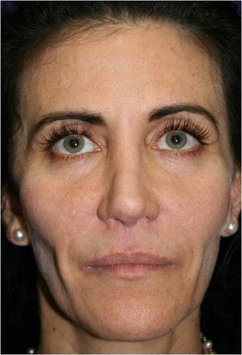 50 Year Old Female with loss of facial volume before 718157