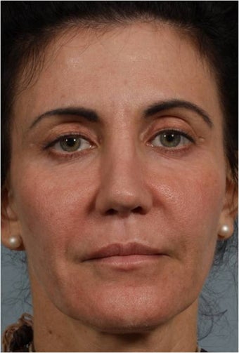 50 Year Old Female with loss of facial volume after 718157